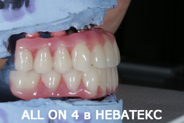 allon4 фото протеза вид сбоку олл он фо протез вид сбоку